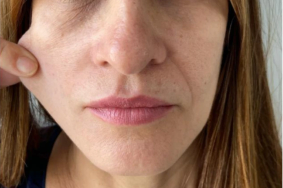 Resultado bioestimulador de colageno - antes e depois