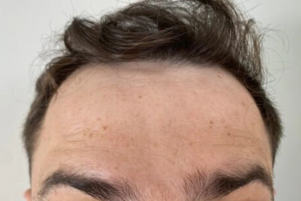 botox em goiania antes e depois - depois