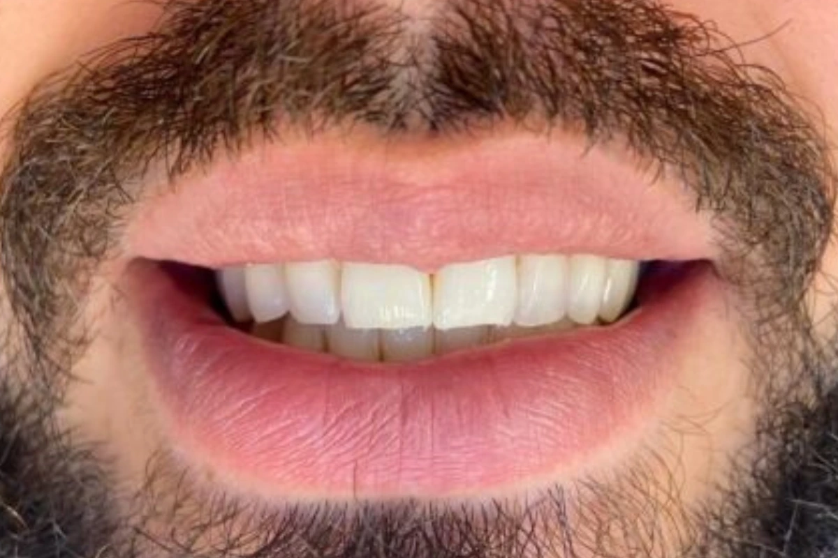 clareamento dental em goiania antes e depois