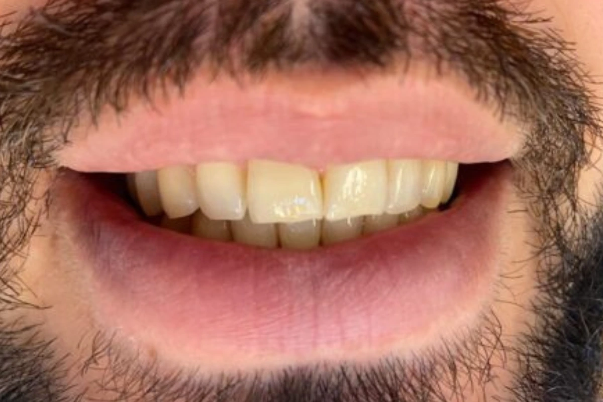 clareamento dental em goiania antes e depois antes