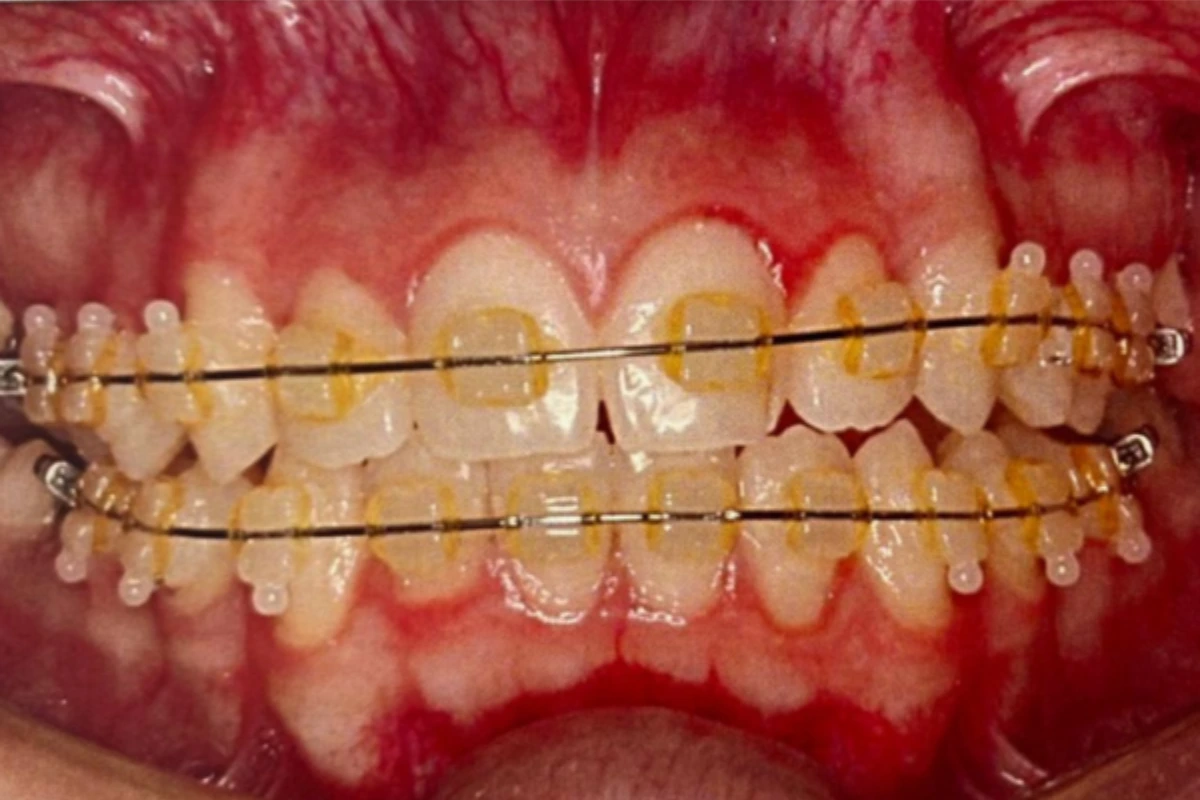 dentista especialista em aparelho em goiania antes e depois