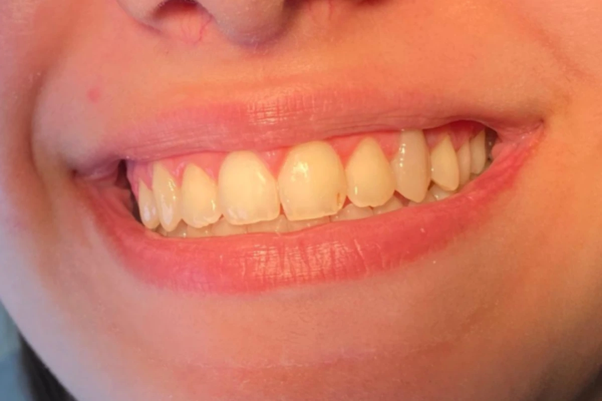 dentista especialista em aparelho em goiania antes e depois - resultado