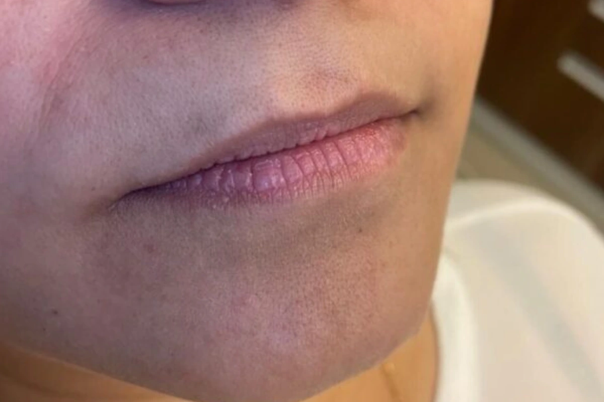 Preenchimento labial em goiania natural - antes e depois - Antes