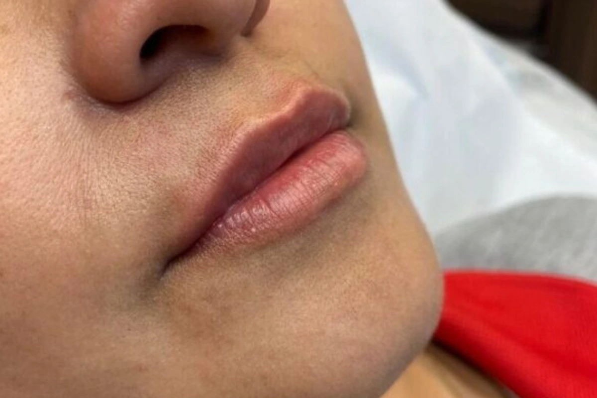 Preenchimento labial em goiania natural - antes e depois - depois