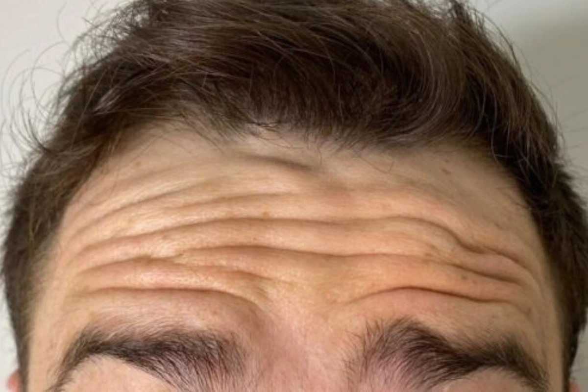 botox em goiania antes e depois - antes